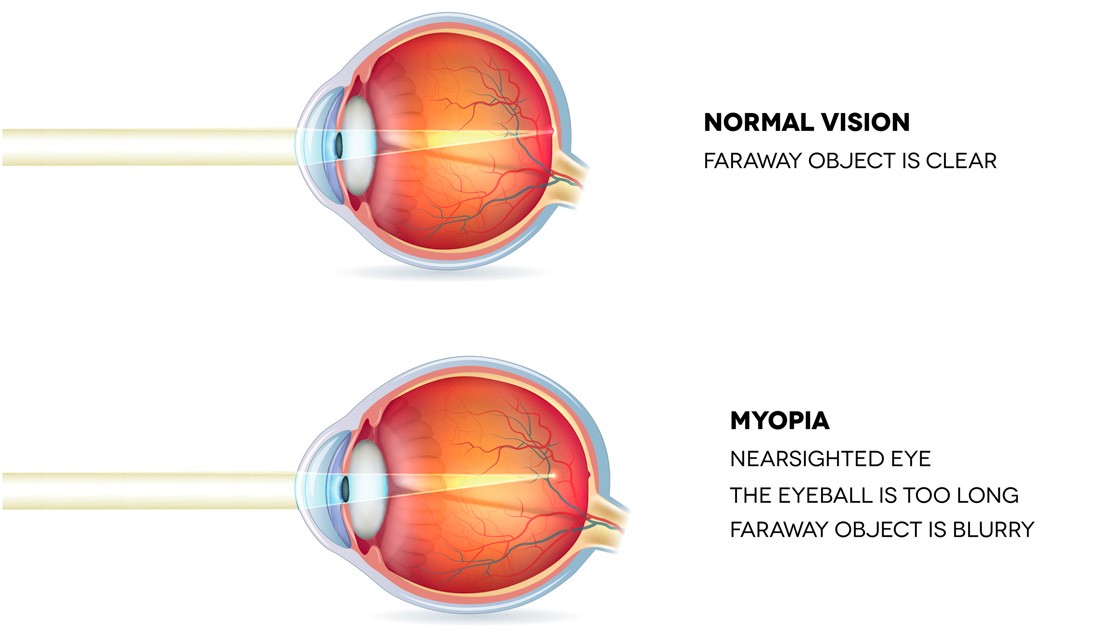 Image result for myopia images