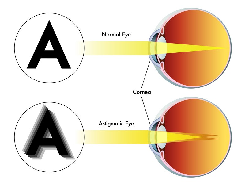 Laser Eye Surgery for Astigmatism