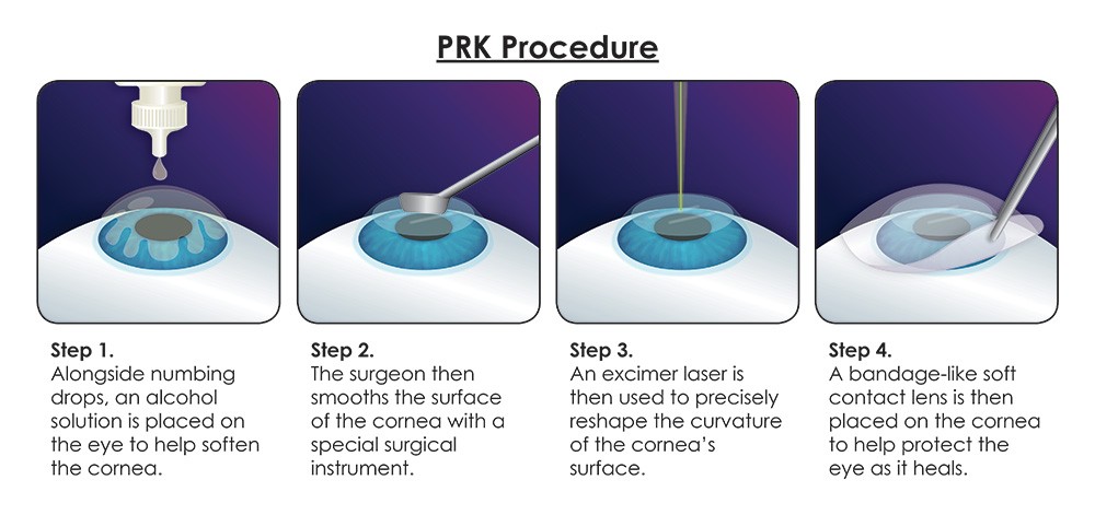 Lasik Eye Surgery Uses Pulses Of Laser Lasik Eye Surgery Uses Pulses Of Laser