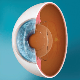 Phakic Intraocular Lens Surgery EVO ICL 1