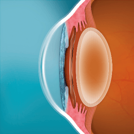 Phakic Intraocular Lens Surgery EVO ICL 2