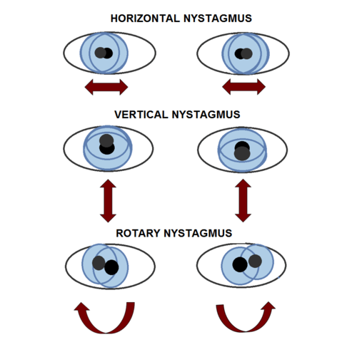 Nystagmus Nystagmus