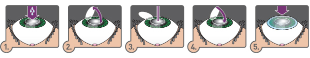 LASEK Eye Surgery: What Is It And How Does It Work? LASEK eye surgery